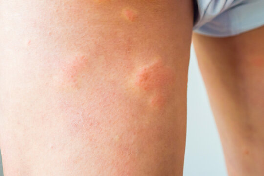 Young asian man has allergic skin rash on his legs from itchy dry skin eczema dermatitis insect bites