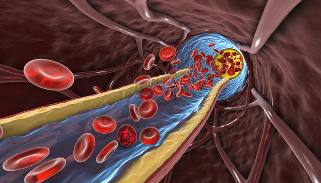 A striking 3D medical visualization showing a microscopic view inside a diseased artery, where significant yellow plaque narrows the passage, forcing red blood cells to rush through the restricted blu