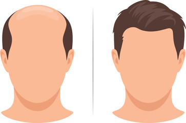 Hair Loss and Hair Restoration Vector Comparison