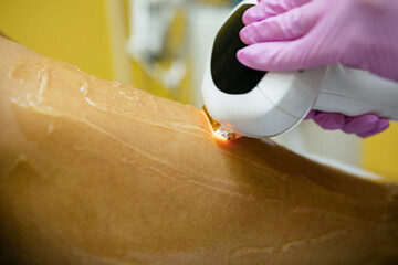 laser hair removal of legs