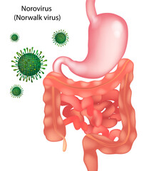 Norovirus Infection Affecting the Digestive Tract Medical  Illustration. Norwalk Virus Impact on Stomach and Intestines.