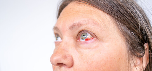 Close-up human eye with severe redness and broken blood vessels, showing subconjunctival hemorrhage, clinical detail for medical, health, and ophthalmology concepts, patient healing, blood vessel