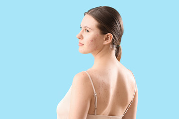 Fototapeta premium Teenage girl with acne problem on blue background, closeup