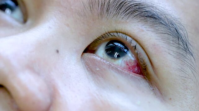 Macro Close-Up of Bloodshot, Irritated Human Eye With Redness