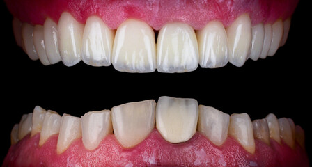 Obraz premium ceramic crowns and veneers