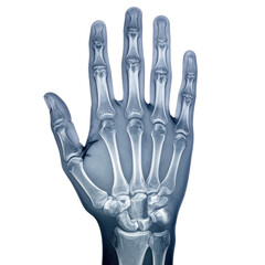 Naklejka premium X-ray image illustrating the bones of a human hand against a black background.