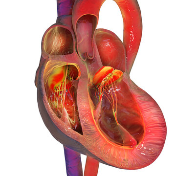 Eccentric left ventricular hypertrophy, 3D illustration