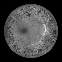 Autosomal dominant vitreoretinochoroidopathy, illustration