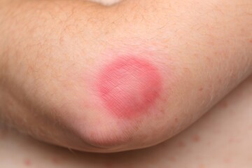 Close-up of a Knee Bruise on Human Skin