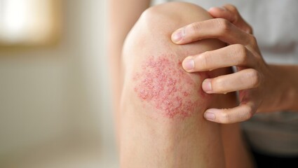 Skin Rash on Knee - Close-up of Irritated Skin and Itching