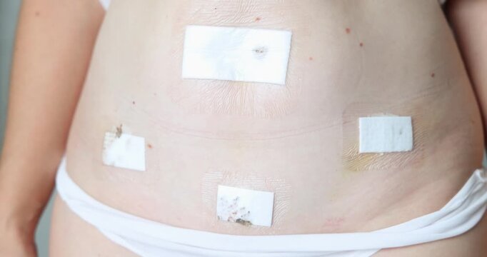 Woman's abdomen with bandaged laparoscopic incisions. Clinical medical environment. Endometriosis, myomectomy, minimally invasive surgery recovery. Health concept.