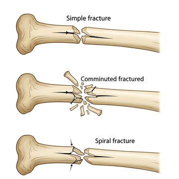 Human bone fracture types illustration simple comminuted spiral