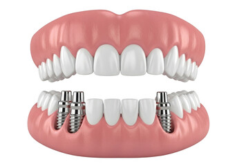 Realistic dental implant model showing upper and lower jaw with prosthetic teeth isolated on transparent background