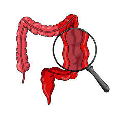 Illustration of ulcerative colitis, inflammatory bowel disease. Inflammation of the human digestive system. Vector illustration for medical, science, and educational posters