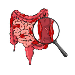Illustration of Crohn's disease. inflammatory bowel disease, Inflammation of the human digestive system. Vector illustration for medical, science, and educational posters.