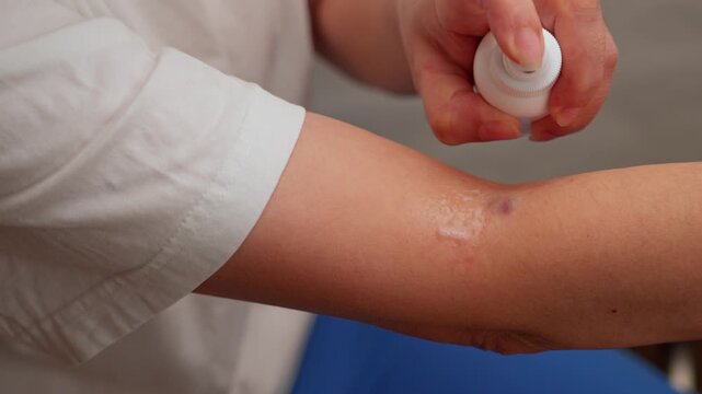 A womans hand sprays hydrogen peroxide from a spray bottle to disinfect a small wound and bruise on the elbow bend. Close-up