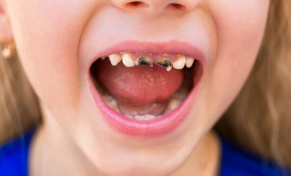 Children's teeth with caries. Close-up of teeth with disease and decay from caries. Diseased human teeth.