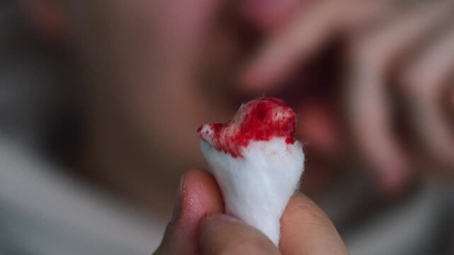 A man stops a nosebleed with a cotton swab.
Broken blood vessels in the nose due to overwork and stress.
A person is feeling unwell and has a nosebleed.
Blood pressure and headache.