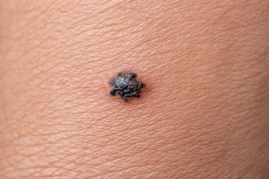 Dark brown skin tag on human arm close up during daylight showing texture and detail of skin