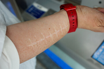 Close-up of the outer forearm displaying parallel linear white scars from a surgical procedure, focusing on post-operative healing and medical recovery in a clinical context. Stock photo