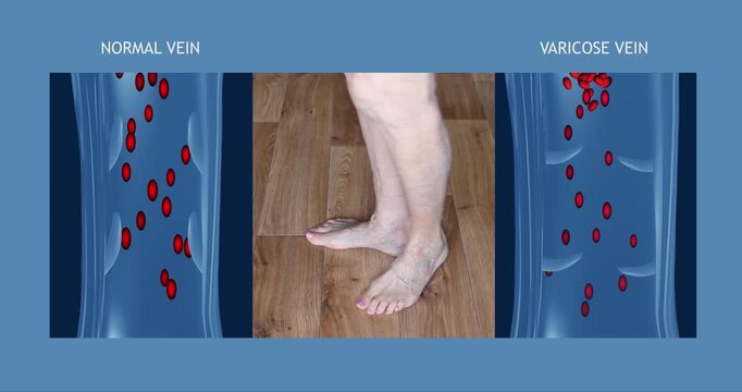 Varicose veins on a female senior legs. The structure of normal and varicose veins. Concept of dry skin, old senior people, varicose veins and deep vein thrombosis or DVT - 2D animation