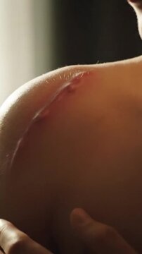 Close Up of Shoulder with Red Scar Injury on Skin under Bright Light with Focus on Healing Process Skin Damage Remedy for Health Ads and Medical Awareness Promotion Campaign Use