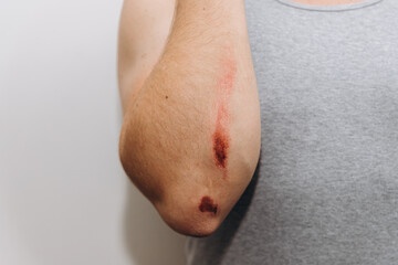 Close-up of a fresh skin abrasion or scrape injury on a person's elbow and arm, showing blood and damaged skin against a white and gray background.