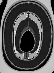 PET CT image of the Neck showing CA nasopharynx or carcinoma of nasopharynx from PET CT scannner.