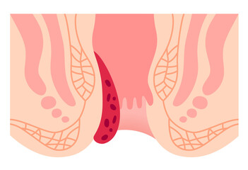 脱肛の構造　肛門断面図　いぼ痔