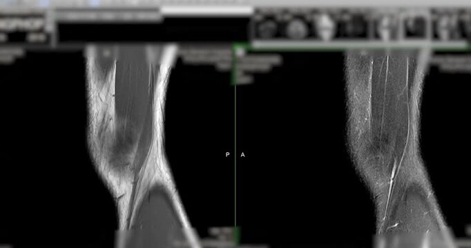 High-Resolution MRI Scan of the Human Knee Joint with Joint Effusion (Sagittal View), showing fluid accumulation and related internal structures for orthopedic diagnosis.