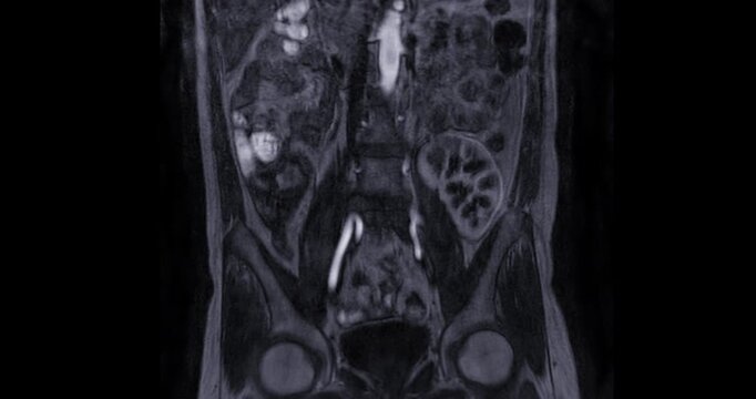 MRA (Magnetic Resonance Angiography) of Renal Artery Footage: Medical imaging showing a transplanted kidney on the left side with vascular structures.