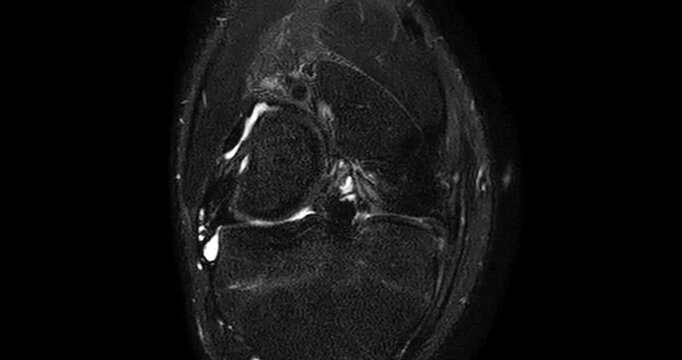 High-Resolution MRI Scan of the Human Knee Joint with Joint Effusion (Coronal  ACL View), showing fluid accumulation and related internal structures for orthopedic diagnosis.