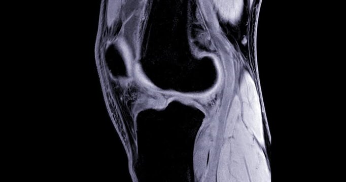 High-Resolution MRI Scan of the Human Knee Joint with Joint Effusion (Sagittal View), showing fluid accumulation and related internal structures for orthopedic diagnosis.