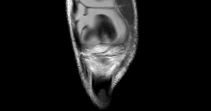 High-Resolution MRI Scan of the Human Knee Joint with Joint Effusion (Coronal View), showing fluid accumulation and related internal structures for orthopedic diagnosis.
