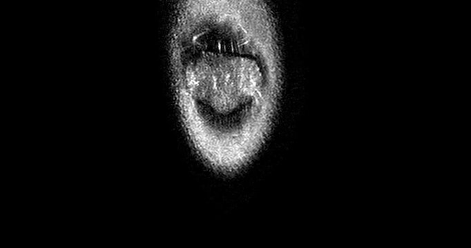 High-Resolution MRI Scan of the Human Knee Joint with Joint Effusion (Coronal View), showing fluid accumulation and related internal structures for orthopedic diagnosis.