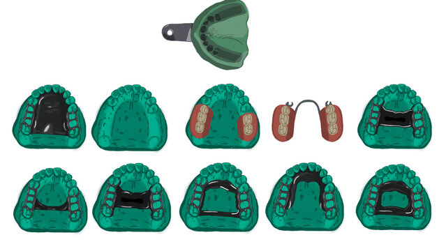 Removable partial dentures maxillary major connectors with impression procedure and dentures 