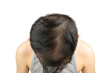 Top view of a middle-aged Asian man's head showing male pattern baldness (androgenic alopecia) with thinning hair and visible scalp on the crown, indicating hair loss and receding hairline problem.