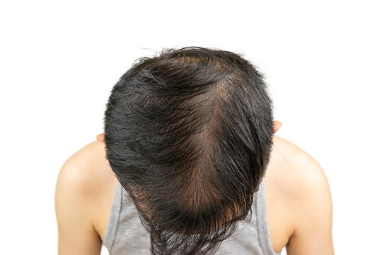 Top view of a middle-aged Asian man's head showing male pattern baldness (androgenic alopecia) with thinning hair and visible scalp on the crown, indicating hair loss and receding hairline problem.