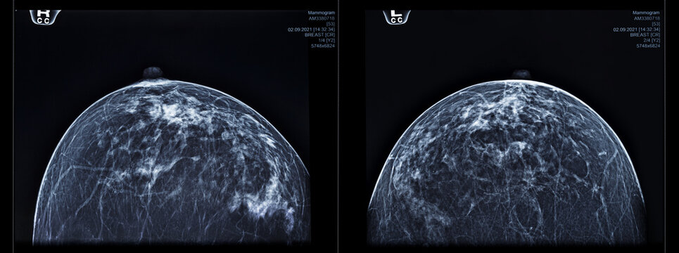 Mammogram analysis showing breast tissue with various patterns and structures. The scans help in examining for potential abnormalities in women's health.