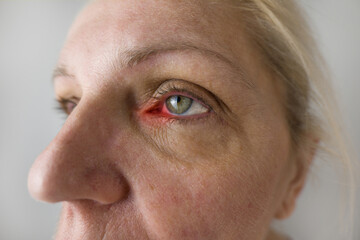 Mature woman Eye inflammation. Computer overworked concept