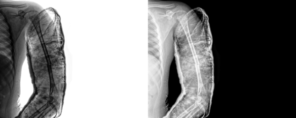 Arm Lateral Projection X-Ray Image Displaying Bone Anatomy, and Accurate Fracture Assessment and Surgical Planning, Isolated on Transparent Background