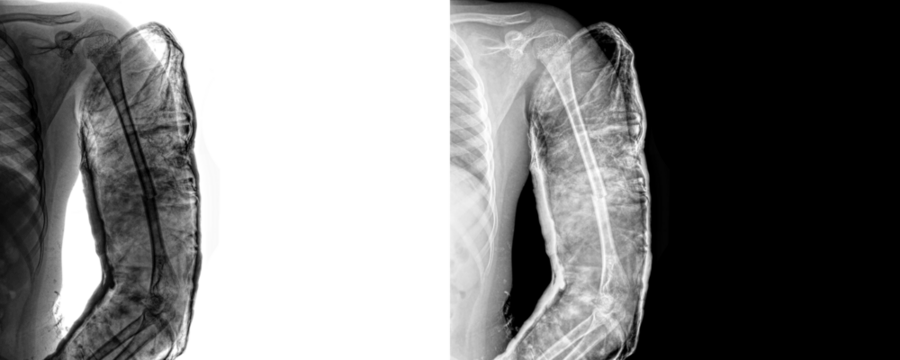 Arm Lateral Projection X-Ray Image Displaying Bone Anatomy, and Accurate Fracture Assessment and Surgical Planning, Isolated on Transparent Background - Powered by Adobe