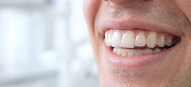 Smiling person showing straight teeth with transparent plastic aligners in a bright dental clinic during a routine check-up - Powered by Adobe