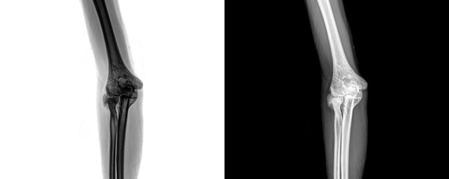 Elbow Anterior View X-Ray Radiograph Depicting Detailed Bone and Joint Structure for Evaluation of Fractures and Injury Assessment Isolated on Transparent Background