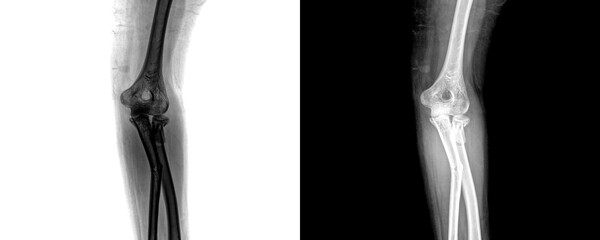 Human Elbow Anterior Projection X-Ray Showing Clear Visualization of Joint, Bones, and Fracture Sites Isolated on Transparent Background