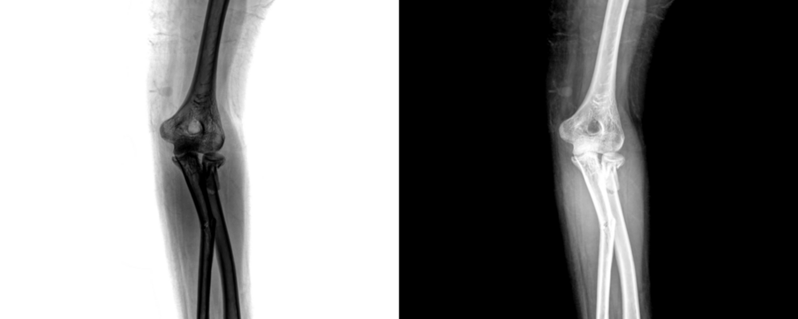 Human Elbow Anterior Projection X-Ray Showing Clear Visualization of Joint, Bones, and Fracture Sites Isolated on Transparent Background