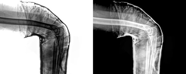 Elbow Lateral View X-Ray Radiograph Showing Detailed Bone Alignment and Joint Structure for...