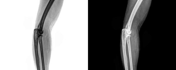 Elbow Lateral View X-Ray Radiograph Depicting Clear Visualization of Bones and Joint Position for Evaluation of Fractures and Injury Assessment, Isolated on Transparent 