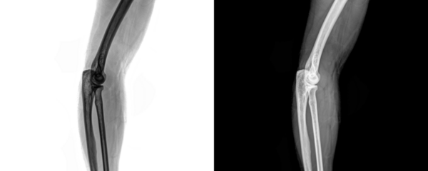 Elbow Lateral View X-Ray Radiograph Depicting Clear Visualization of Bones and Joint Position for Evaluation of Fractures and Injury Assessment, Isolated on Transparent 