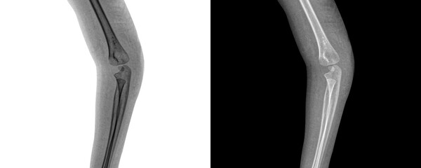 Elbow Lateral Projection X-Ray Showing Comprehensive Bone and Joint Details for Detection of...